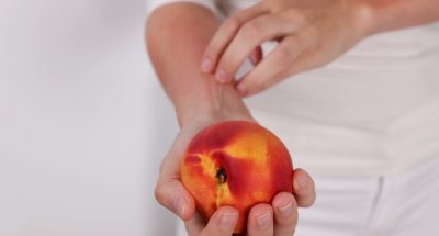 Woman suffering from Fruit Allergy holding a peach. OAS, food allergy symptoms rush, itching, skin redness.