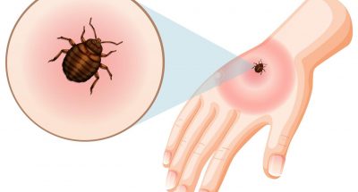 bed-bug-bites-sting-skin_1308-122210